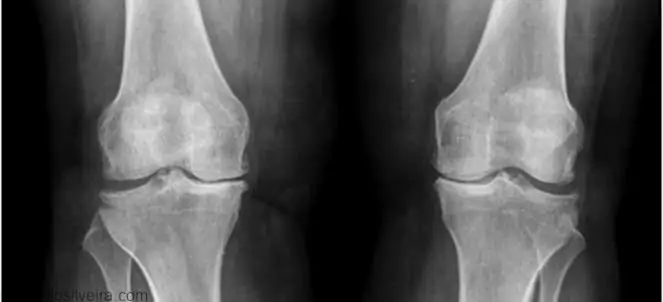 Artrose no joelho - Salus Ortopedia e Fisioterapia em Brasília / DF