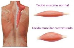 contratura muscular