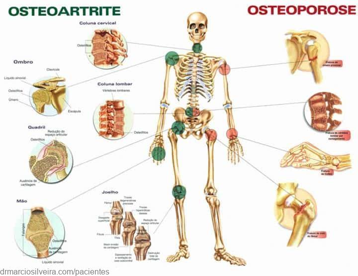 Artrita degenerativa - Osteoartrita