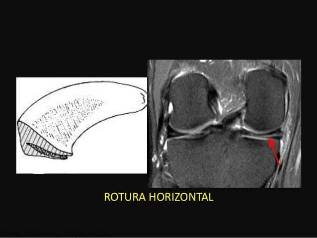 Qual é o tratamento ideal para uma ruptura horizontal no corpo e no corno posterior do menisco lateral?