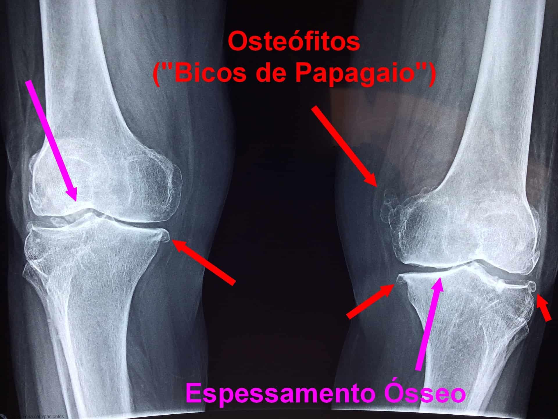 O que é osteófitos no joelho?