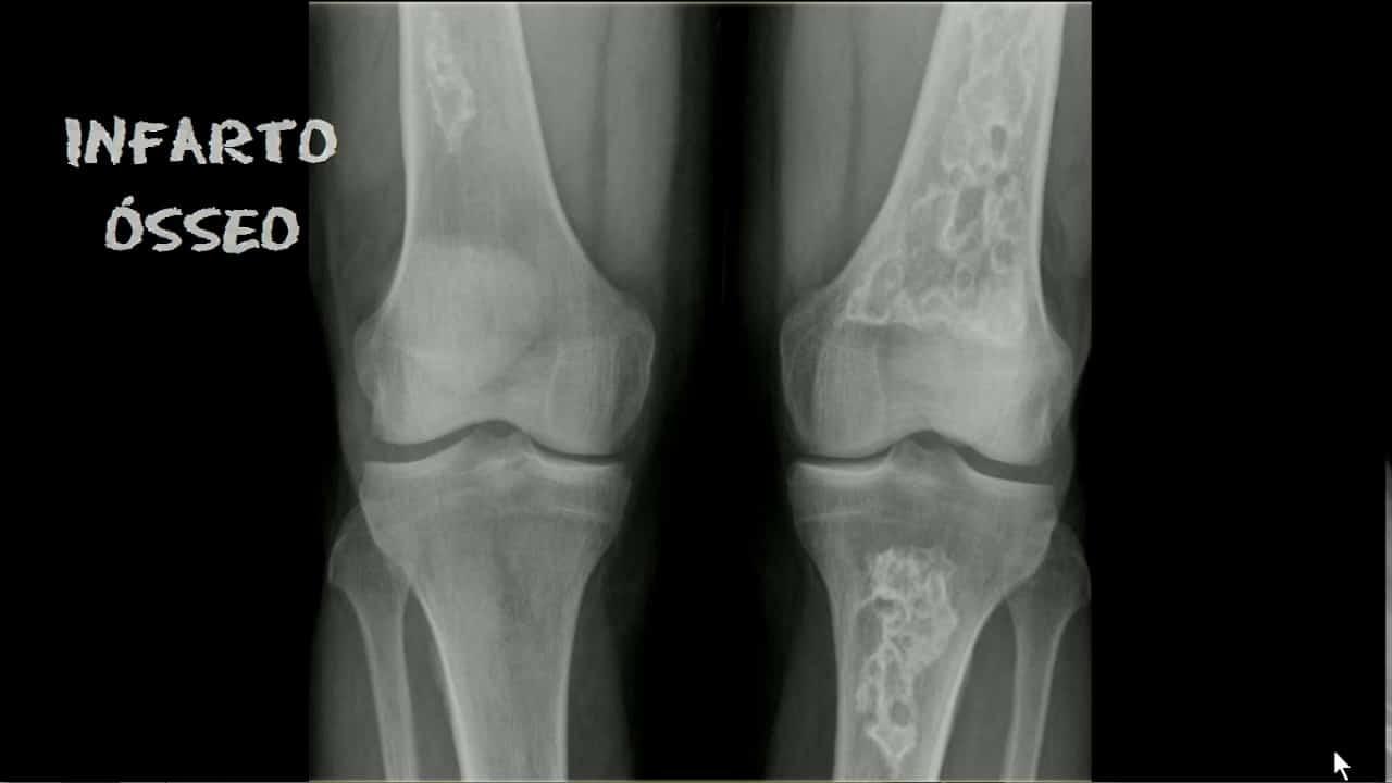 Инфаркт костного мозга костей. Инфаркт плечевой кости рентген. Асептический некроз коленного сустава рентген. Асептический некроз большеберцовой кости мрт.