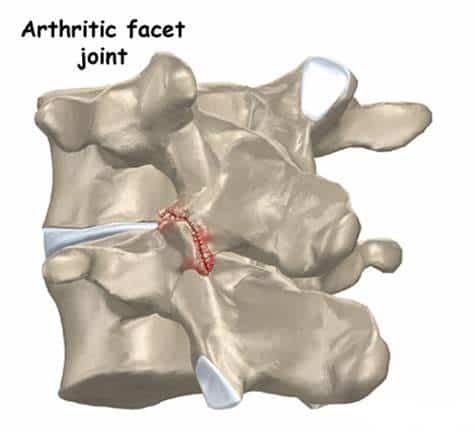 O que é a artrose de interfacetárias na coluna?