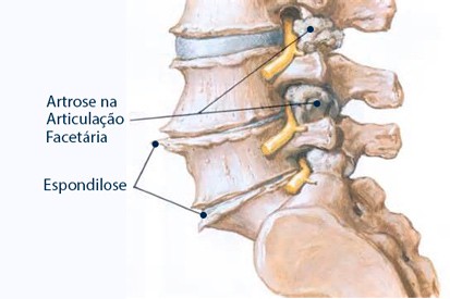 Espondilose (artrose na coluna lombar, dorsal ou cervical)