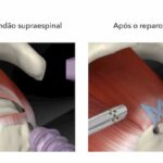 Quanto custa uma operação para sutura de rotura de tendão do supraespinhal (manguito rotador)?