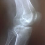 Caso de fratura do platô do joelho em porção posterior por operação com duplo acesso posterior