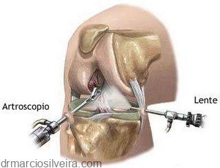 artroscopia para reparo de lesões meniscais