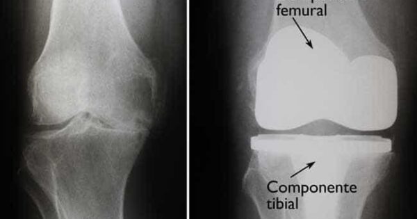 Artroplastia Total De Joelho Indica Es Dr M Rcio Silveira