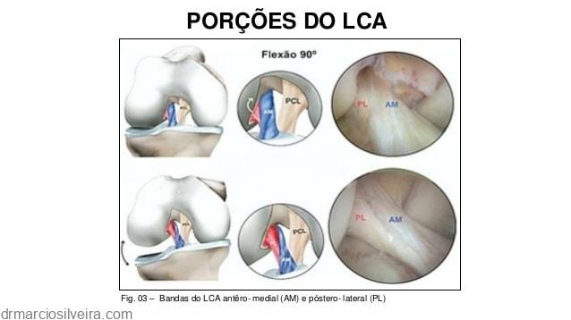 lesão - anatomia do ligamento cruzado anterior