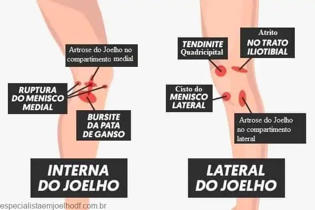 causas de dor no joelho interna e externa