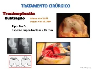 Trocleoplastia