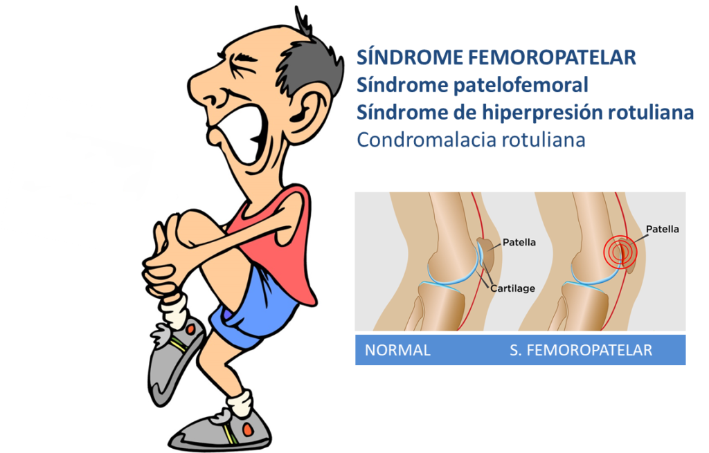 síndrome femoropatelar