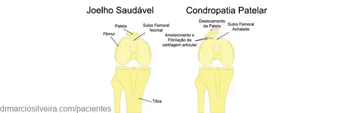Dr. Márcio Silveira: Ortopedista Especialista em Traumatologia Esportiva, Joelho - Adulto e Infantil - e Idoso condropatia