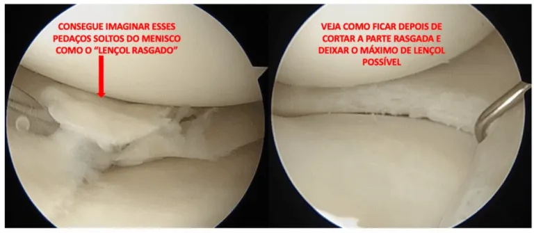 Dr. Márcio Silveira: Ortopedista Especialista em Traumatologia Esportiva, Joelho - Adulto e Infantil - e Idoso meniscectomia parcial