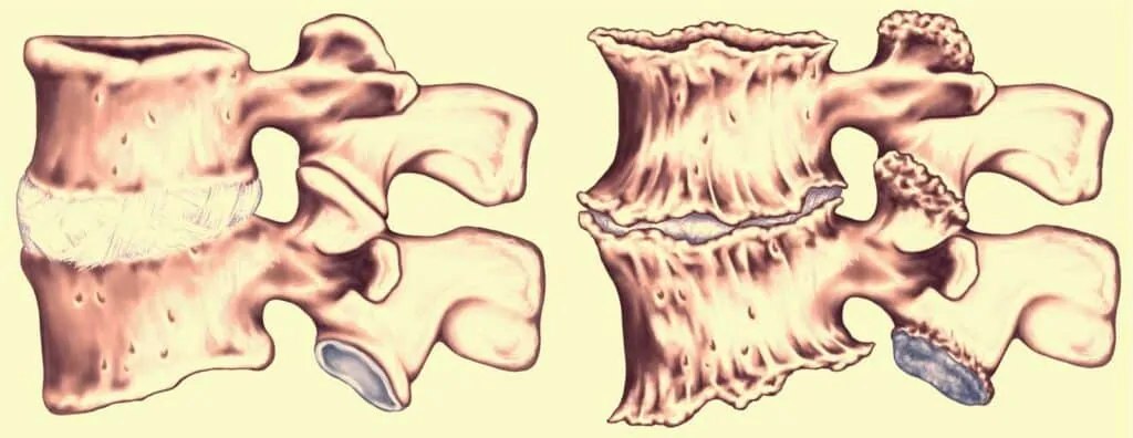 Dor facetária ou artrose da articulação das facetas