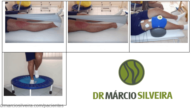 Dr. Márcio Silveira: Ortopedista Especialista em Traumatologia Esportiva, Joelho - Adulto e Infantil - e Idoso patela lca